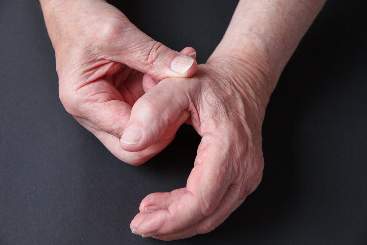 Arthritis at the Base of the Thumb