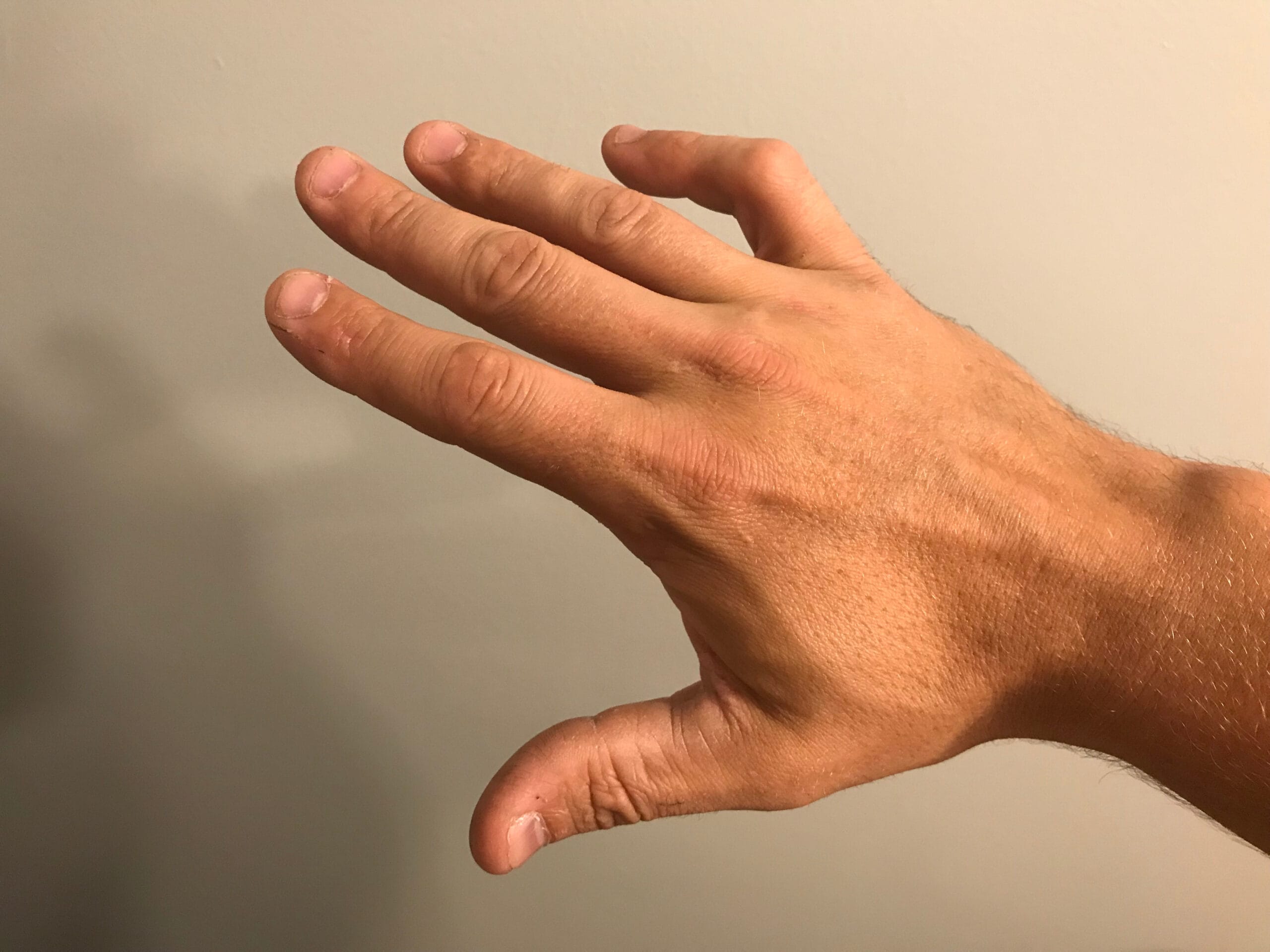Boutonniere,Deformity,On,Pinky,Finger