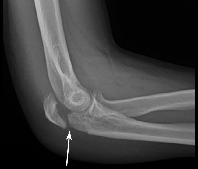 Elbow Fractures