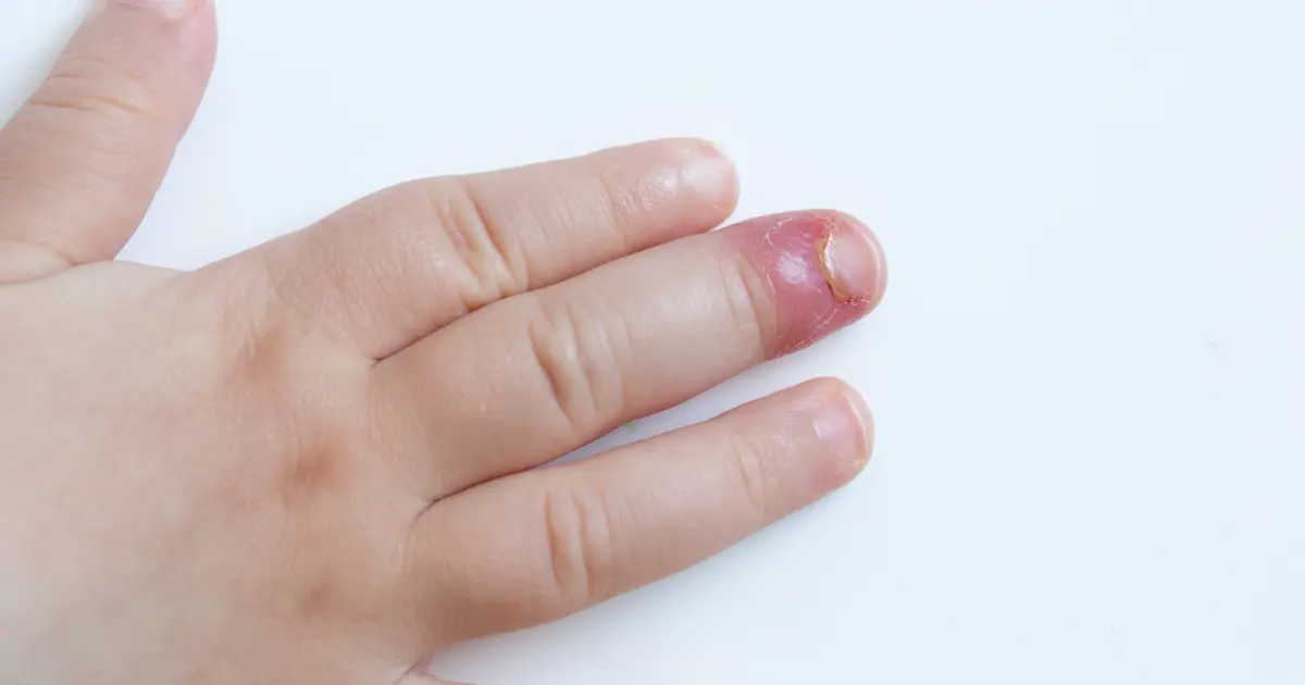 Fingertip Infections
