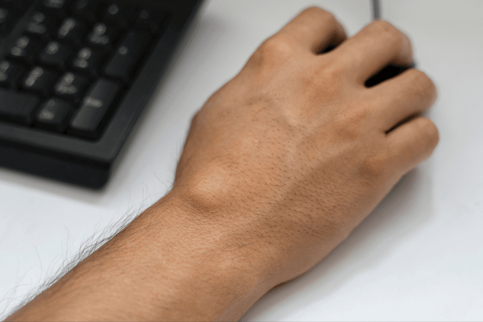 Ganglion Cyst