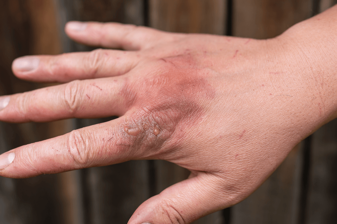 Hand Burns