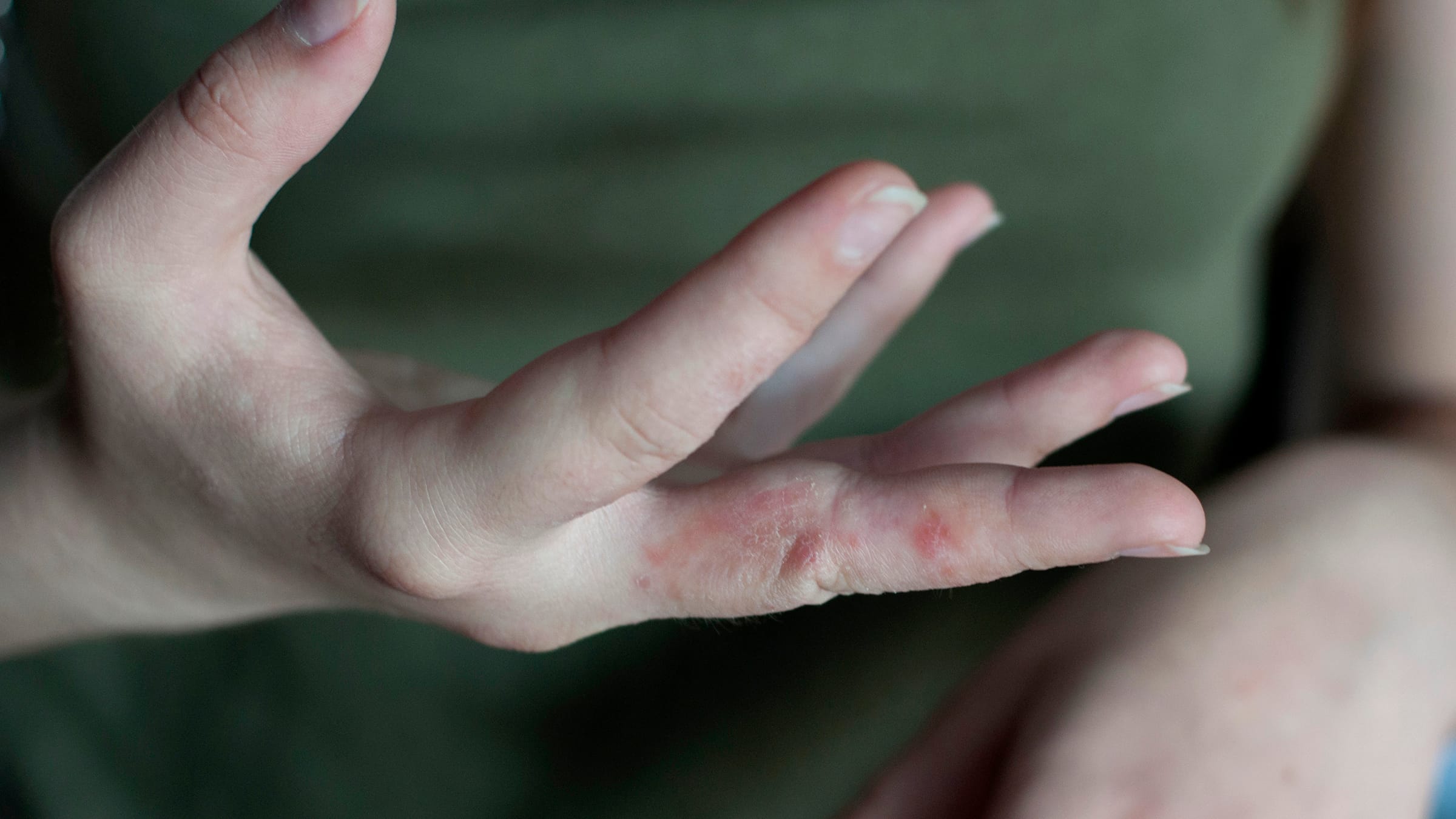 Sore at woman hand. Scabies in macro, itchy fingers