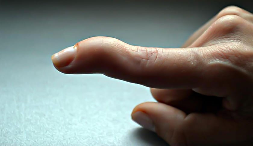 Mallet Finger