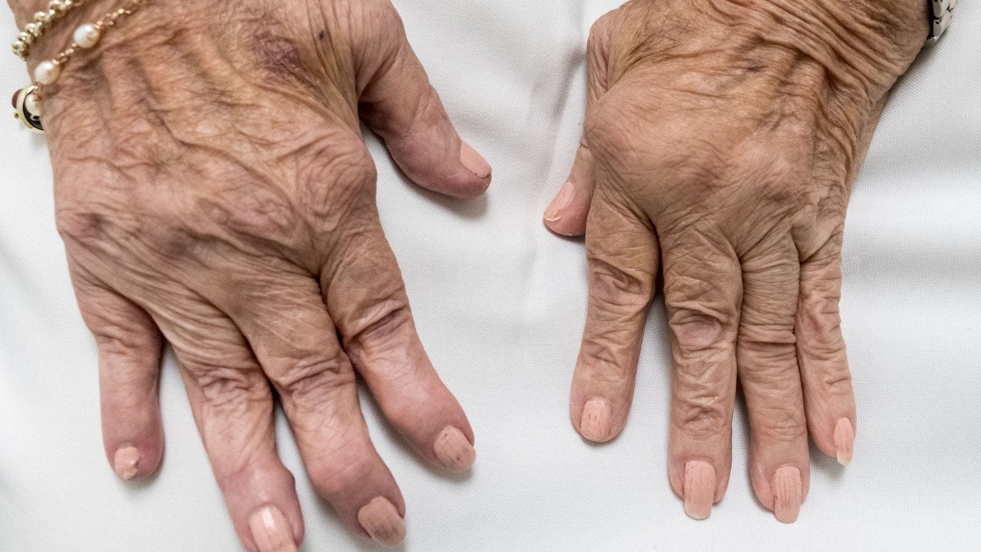 Rheumatoid arthritis