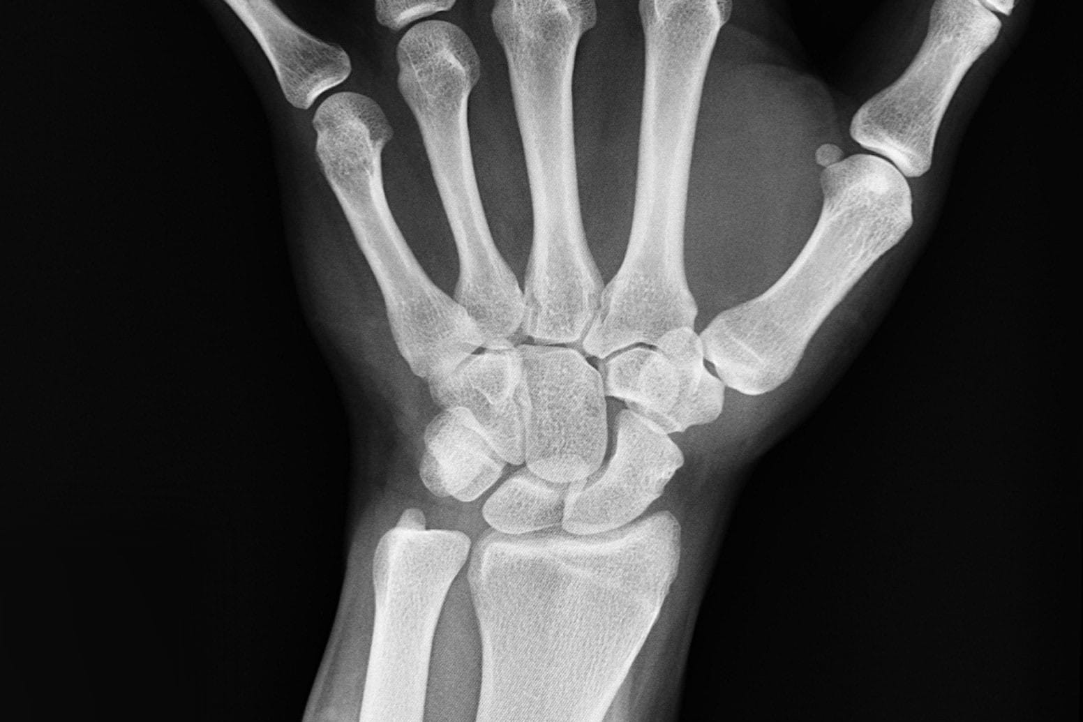 Scaphoid Fracture