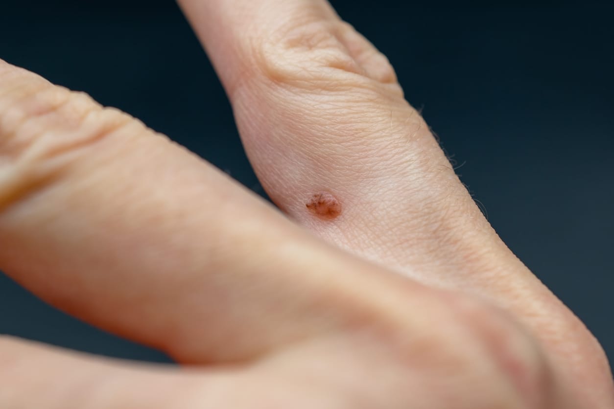 Papilloma on the finger, common wart Verruca vulgaris a flat wart on a hand, human papillomavirus HPV