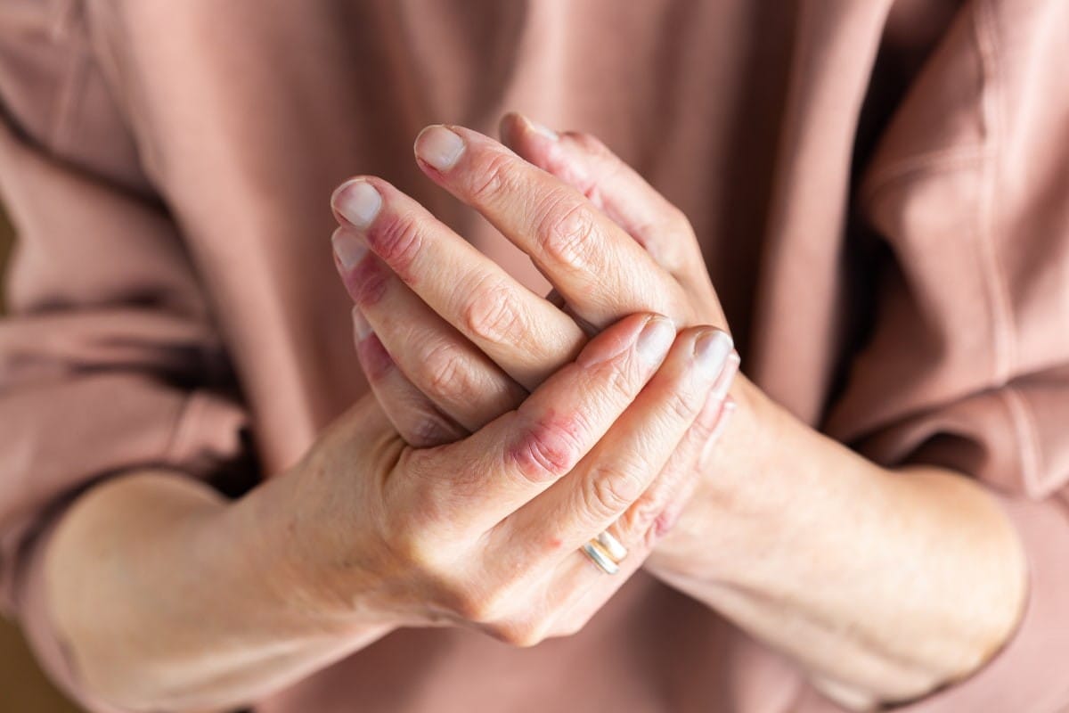 Vascular Disorders Hands