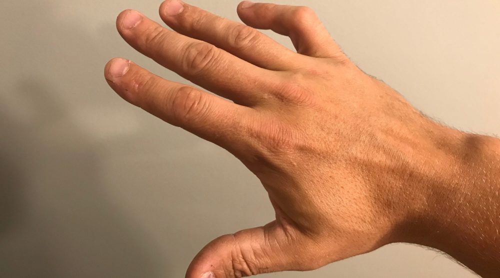 Boutonniere,Deformity,On,Pinky,Finger