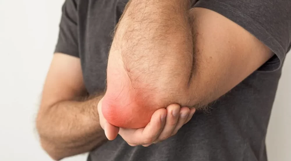 Elbow Bursitis