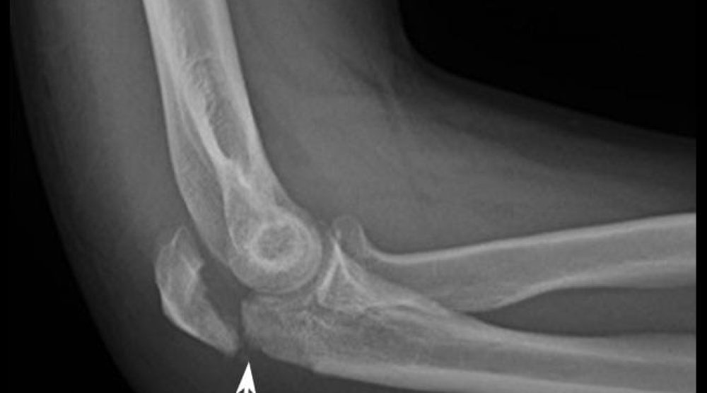 Elbow Fractures