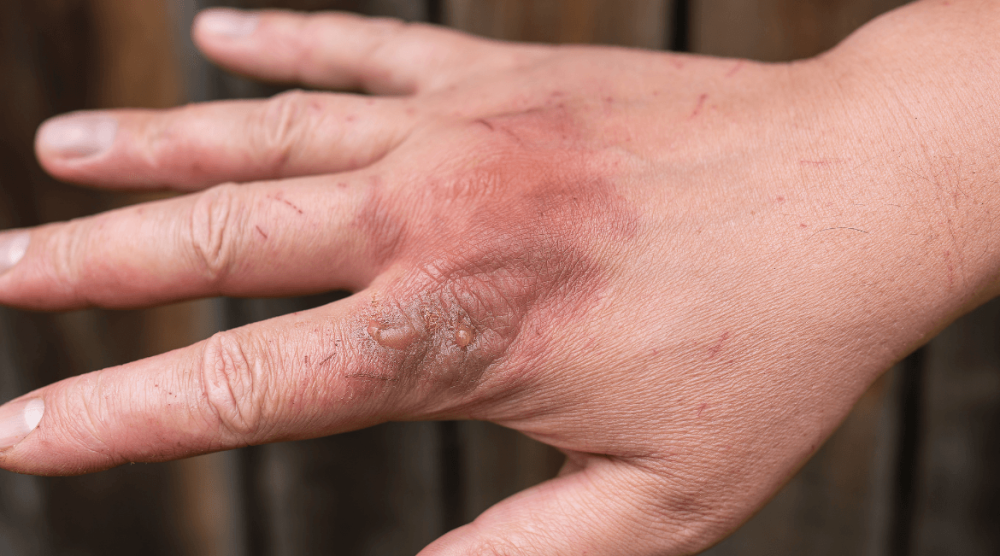 Hand Burns
