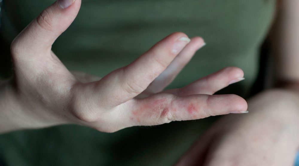 Sore at woman hand. Scabies in macro, itchy fingers
