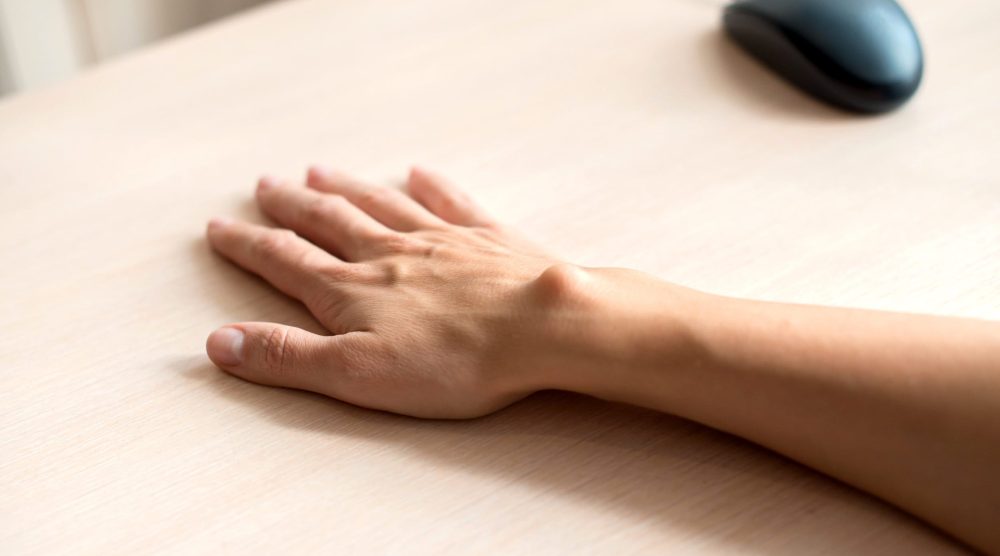female hand with a hygroma. Pain. Wrist ganglion cyst. Treatment without surgery.