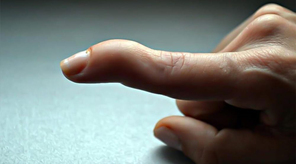 Mallet Finger