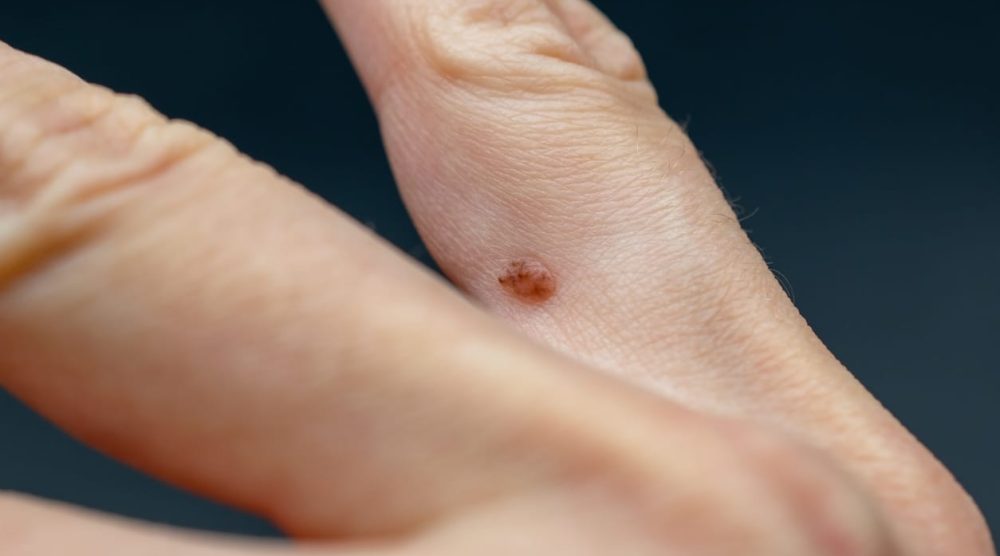 Papilloma on the finger, common wart Verruca vulgaris a flat wart on a hand, human papillomavirus HPV