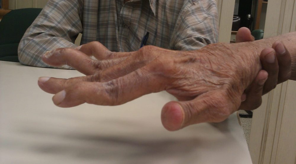 Swan Neck Deformity