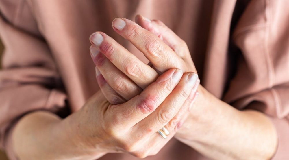 Vascular Disorders Hands